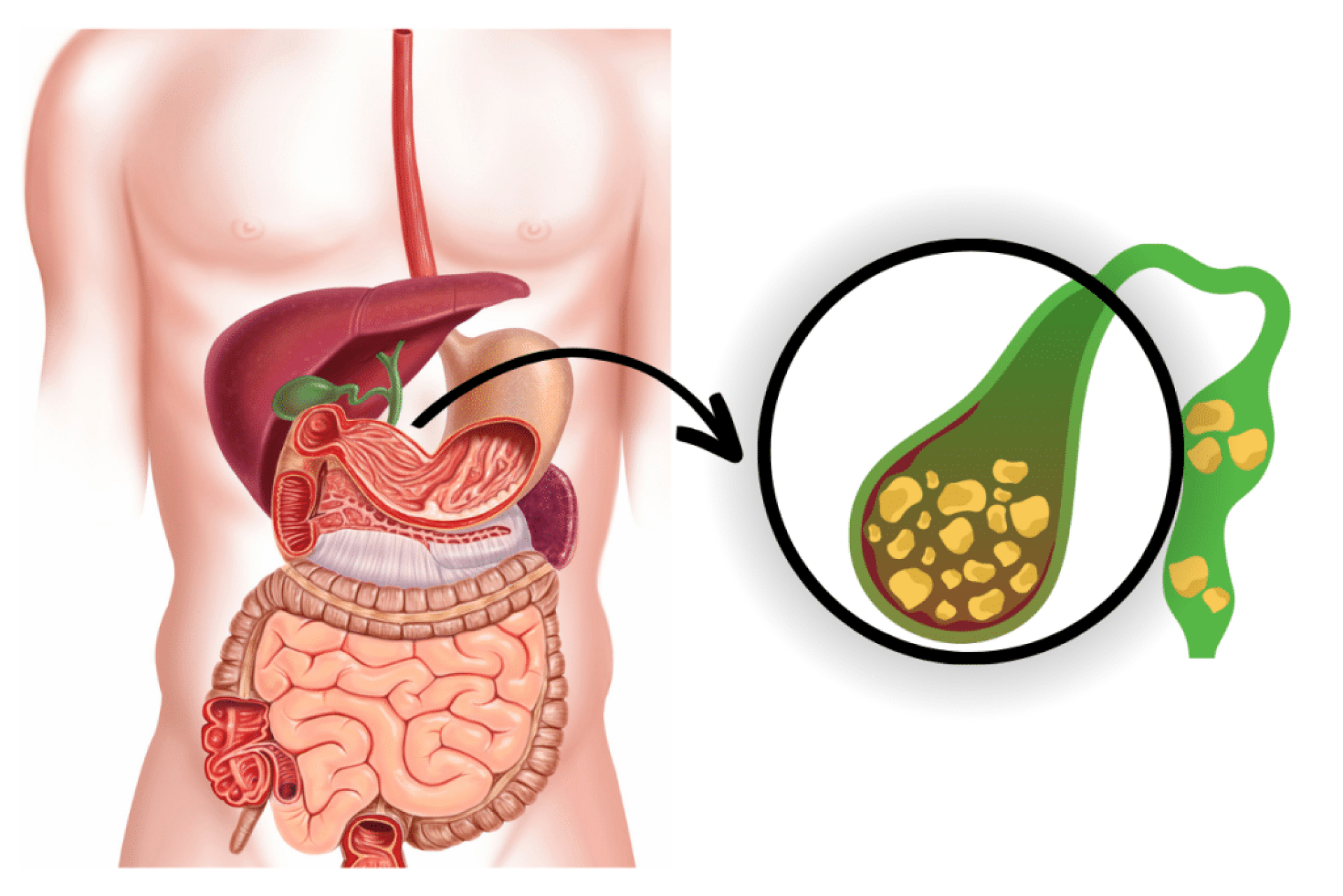  Bệnh Sỏi Mật Ở Người Cao Tuổi: Triệu Chứng, Nguyên Nhân Và Chế Độ Dinh Dưỡng