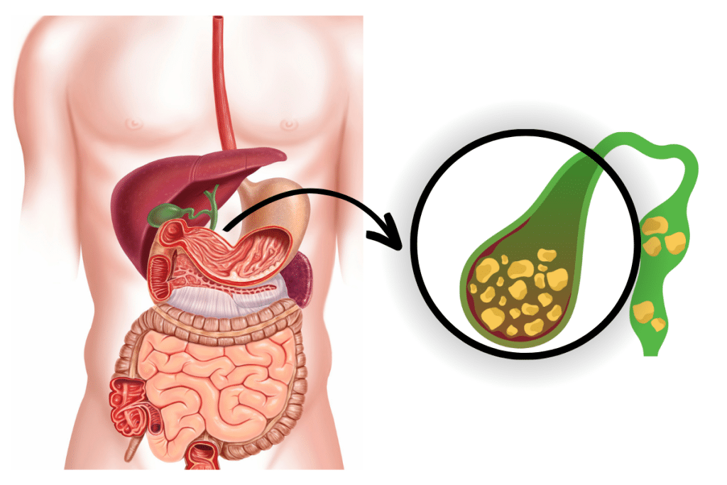 Bệnh Sỏi Mật Ở Người Cao Tuổi: Triệu Chứng, Nguyên Nhân Và Chế Độ Dinh Dưỡng